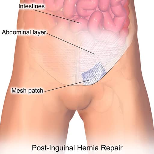Defective hernia mesh lawsuits reported by Lawsuit Informer